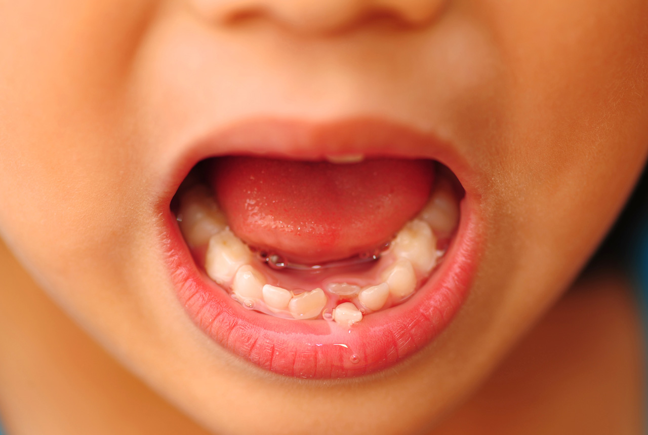 口腔崩壊、子どもにどんな影響が？　貧困で連鎖も　歯科医に聞く