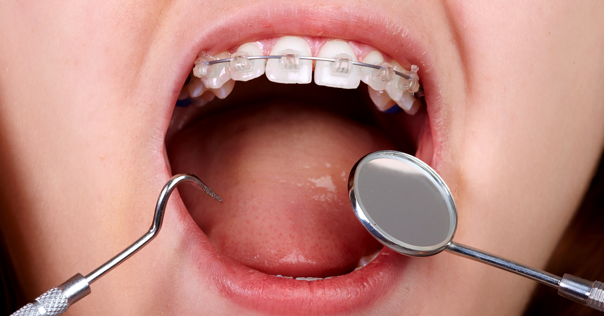 出っ歯の早期矯正は不要…永久歯後でも効果同じ