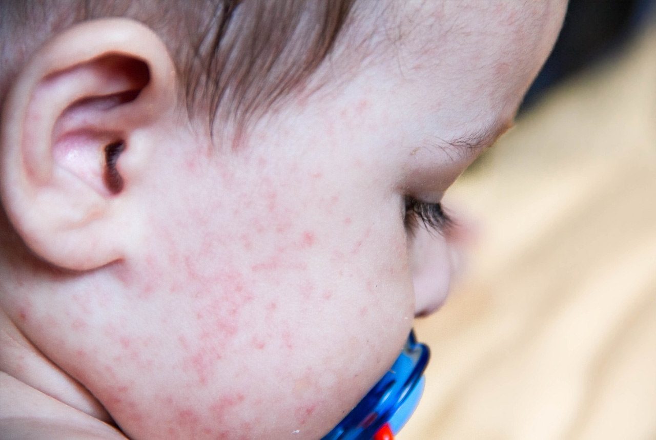 アレルギー対策、初の指針案…医療の質、底上げ急務