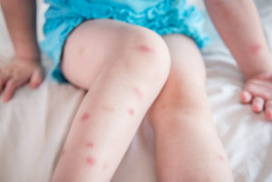 とびひ（伝染性膿痂疹） - ほけんだよりプラス - 学校で予防すべき感染症シリーズ
