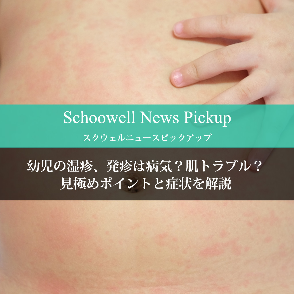 幼児の湿疹、発疹は病気？肌トラブル？見極めポイントと症状を解説