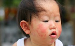 食物アレルギー（１）　乳児期など早い段階で受診を