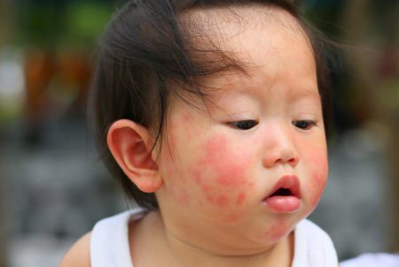 食物アレルギー（１）　乳児期など早い段階で受診を