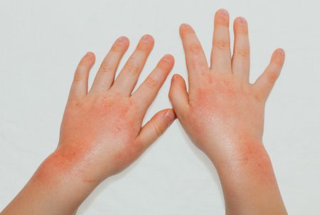 子どものアトピー性皮膚炎、治すには炎症対策がポイント！薬の使い方も