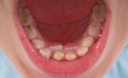 むし歯 - ほけんだよりプラス - 歯・口腔の健康シリーズ
