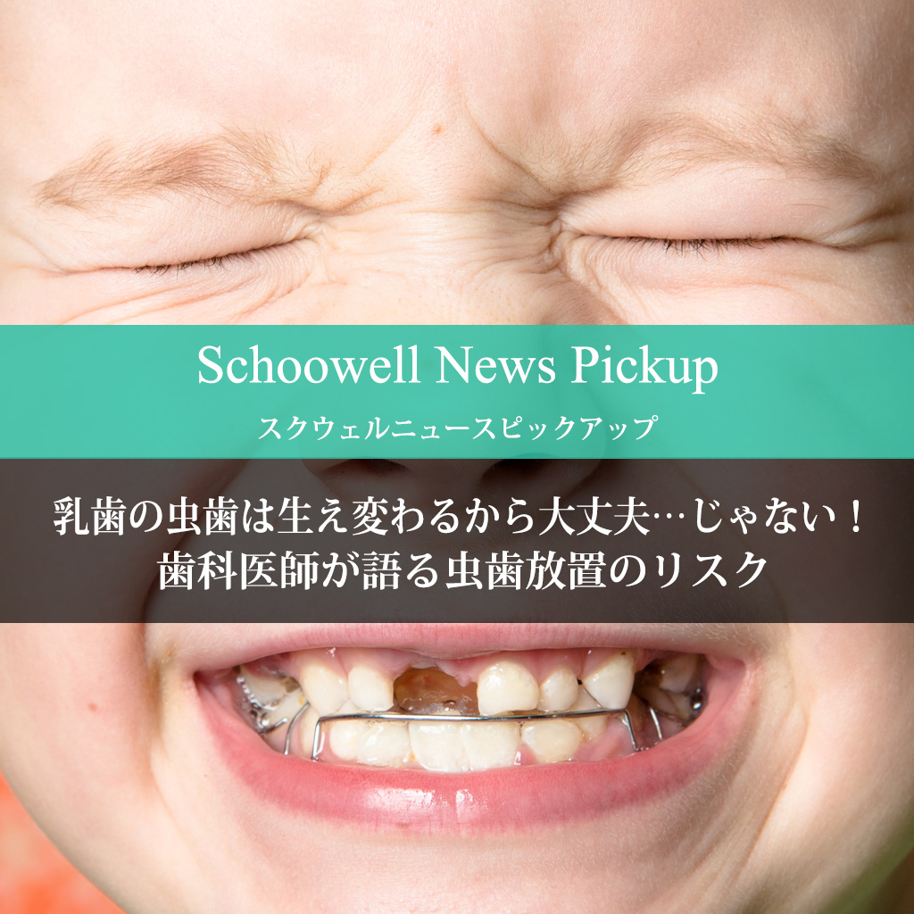 乳歯の虫歯は生え変わるから大丈夫 じゃない 歯科医師が語る虫歯放置のリスク Schoowell スクウェル