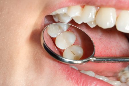 むし歯が1本もない小学生児童の方がむし歯になりやすい、東北大が調査