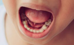 歯周病の予防と治療- ほけんだよりプラス
