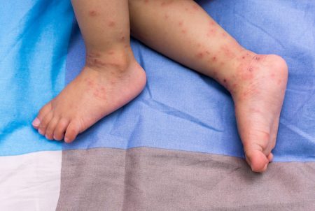 手足口病　９月に入っても感染収まらず…子どもがぼーっとする、ぐったりしたらすぐに受診を